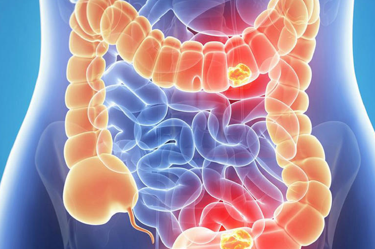 Bowel Cancer Rates are Increasing in younger People.