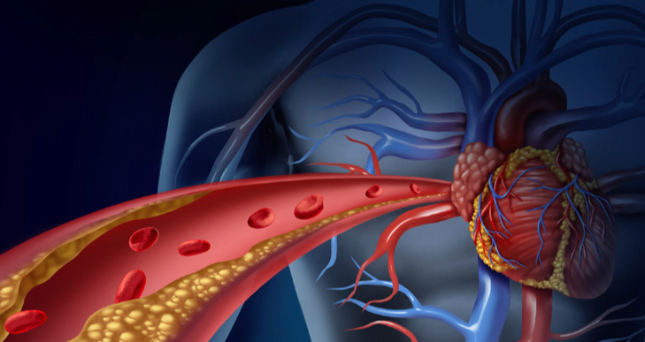 High Cholesterol.  The silent killer with few symptoms.