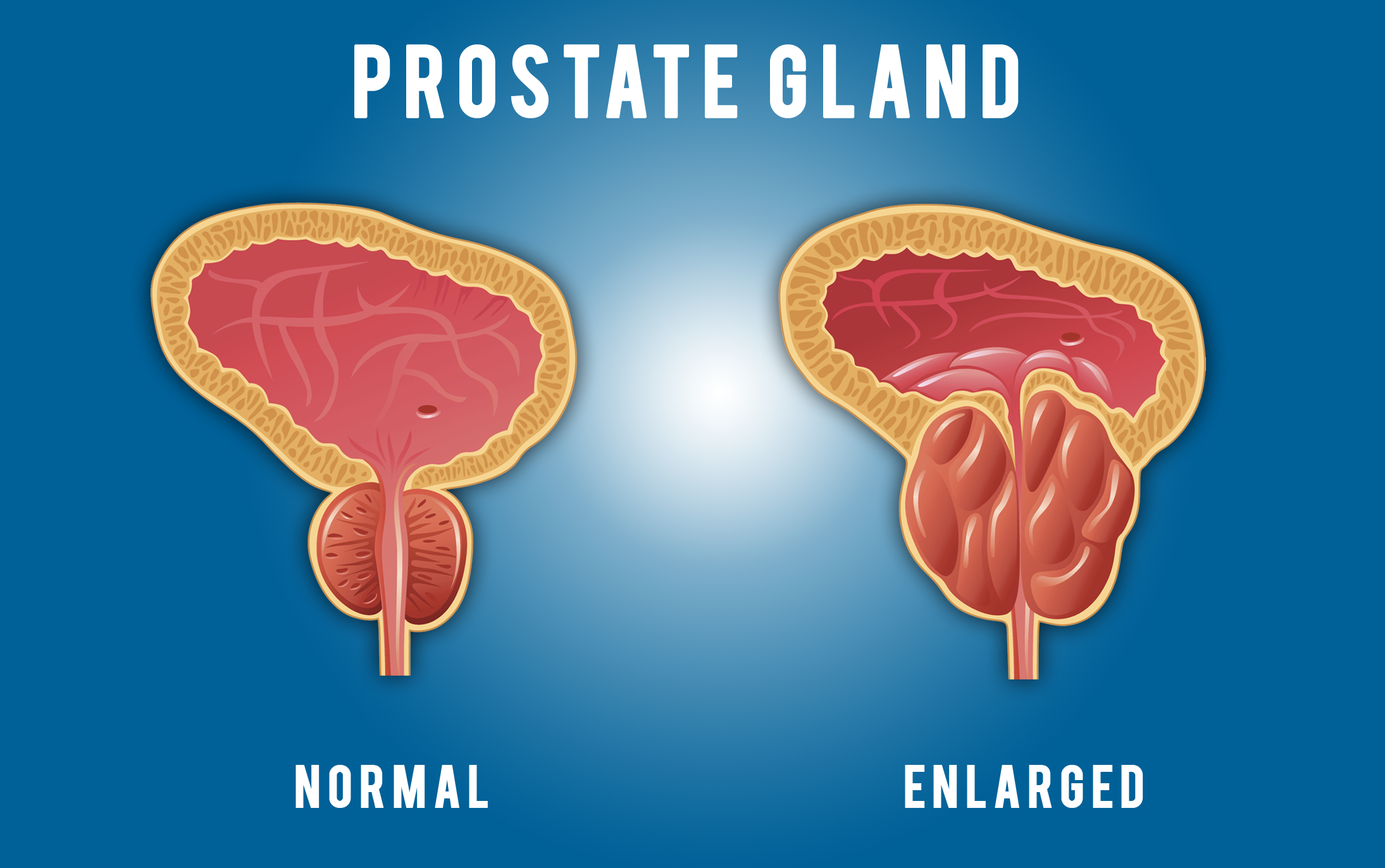 A New Prostate Cancer Treatment Offers Patients Years More Healthy Life.