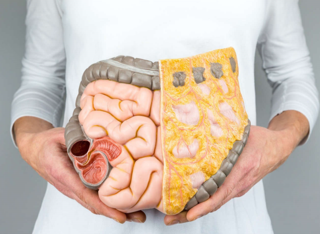 What you should know about bowel/colon cancer.