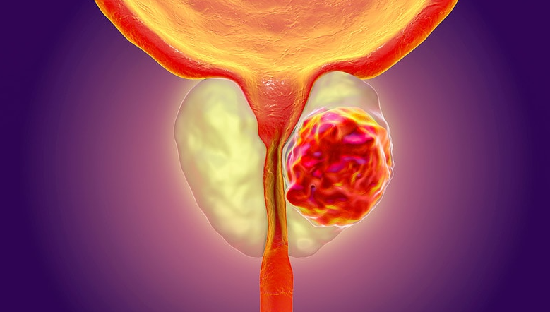 Revolutionary Nanoparticle Therapy for Prostate Cancer