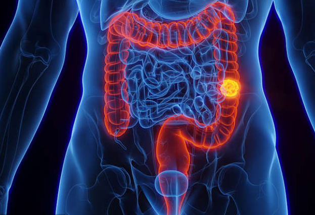 What is colorectal cancer and is it preventable?